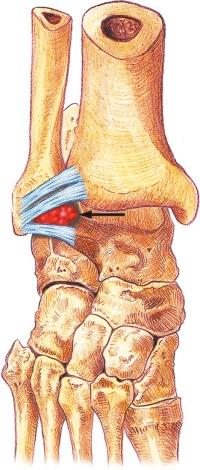 FIGURE 34–1, Diagram shows the site and extent of anterolateral impingement lesion (arrow) .