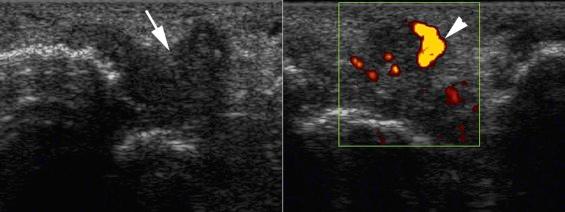 FIGURE 34–2, Ultrasound images reveal irregular soft tissue mass in the anterolateral gutter of the ankle (arrow) with increased vascularity on power Doppler imaging (arrowhead) related to active synovitis.