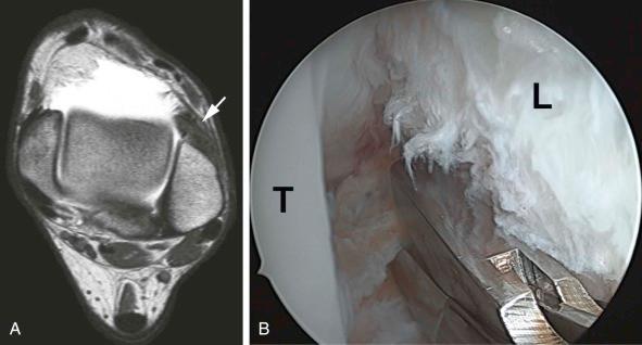FIGURE 34–3, Anterolateral impingement syndrome. A , Axial T1-weighted spin-echo MR arthrogram of left ankle shows irregular soft tissue thickening in the anterolateral gutter (arrow) . B , Arthroscopic image showing débridement of the soft-tissue impingement lesion in the anterolateral gutter. L, Lateral malleolus; T, talus.