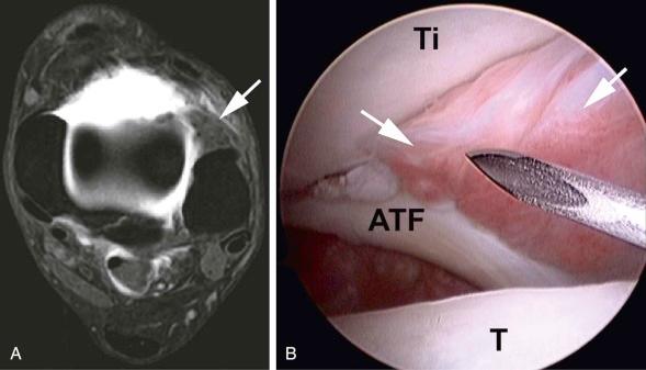 FIGURE 34–4, Anterolateral impingement syndrome (“syndesmotic impingement”). A , Axial fat-suppressed T1-weighted spin-echo MR arthrogram of left ankle demonstrates nodular lesion surrounding Bassett ligament in the superior aspect of the anterolateral gutter (arrow) . B , Arthroscopic image depicts fibrous thickening in the superior aspect of the anterolateral gutter (arrows) . ATF, Anterior talofibular ligament; T, talus; Ti, tibia.