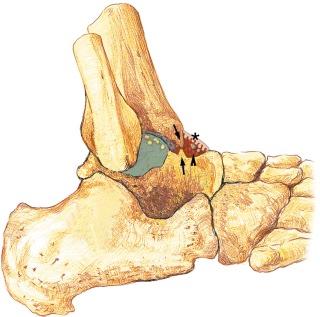 FIGURE 34–5, Diagram shows characteristics of anterior ankle impingement including chondral fraying, anterior tibial and talar spurs (arrows) , synovitis in anterior capsular recess (asterisk) , reduction of joint space, and osteochondral loose bodies (arrowhead) .