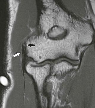 FIGURE 12–1, Common extensor tendinosis. Coronal proton density MR image demonstrates mild thickening and heterogeneity of the common extensor tendon compatible with mild tendinosis (white arrow) . Note enthesopathy of the lateral humeral epicondyle (black arrow) .