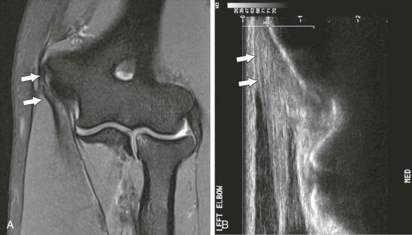 FIGURE 12–2, Common flexor tendinosis. A , Coronal proton density MR image demonstrates thickening, signal heterogeneity, and intrasubstance fraying of the common flexor tendon (arrows) consistent with moderate tendinosis. B , Long-axis sonographic image in a different patient demonstrates moderate common flexor tendinosis (arrows) .