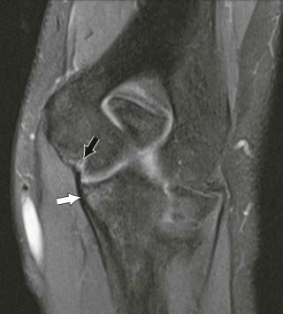 FIGURE 12–3, Partial tear of the ulnar collateral ligament (UCL) anterior band. Fluid-like signal involving the origin of the anterior band of the UCL at its origin from the medial humerus (black arrow) is noted on this coronal fat-suppressed T2-weighted MR image. Also demonstrated is an incomplete fracture of the sublime tubercle of the ulna (white arrow) .