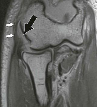 FIGURE 12–4, Complete tear of the radial collateral ligament. Coronal proton density MR image demonstrates a complete tear of the radial collateral ligament involving its proximal humeral insertional fibers (black arrow) . Note partial tear of the common extensor tendon (white arrows) .