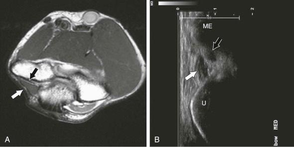 FIGURE 12–5, Anconeus epitrochlearis. A , Axial proton density MR image through the medial epicondyle demonstrates an anconeus epitrochlearis (white arrow) effacing the cubital tunnel and flattening the ulnar nerve against the medial humeral epicondyle (black arrow) . B , Short-axis sonographic image through the cubital tunnel demonstrates a muscle (white arrow) extending from the medial humeral epicondyle (ME) to the ulna (U) overlying and exerting mass effect on the ulnar nerve (black arrow) .