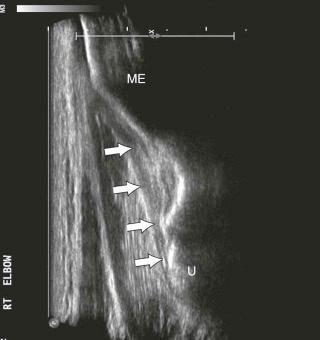 FIGURE 12–6, Normal ulnar collateral ligament (UCL). Long-axis sonographic image demonstrates the UCL extending from the medial epicondyle (ME) to the sublime tubercle of the ulna (U, arrows) .