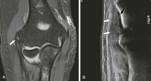 FIGURE 12–7, Partial tear of the common extensor tendon. A , Coronal fat-suppressed T2-weighted MR image demonstrates a focal fluid-filled gap (arrow) within the proximal fibers of the common extensor tendon at its origin from the lateral epicondyle. B , Long-axis sonographic image shows a focal anechoic defect (black arrow) along the articular surface superimposed on common extensor tendinosis (white arrows) compatible with partial tear of the extensor carpi radialis brevis fibers.