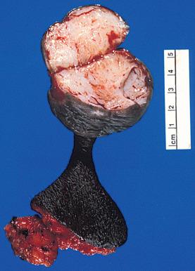 Fig. 9.1, Fibroepithelial stromal polyp—a pedunculated polyp with a thin stalk and fibrous core.