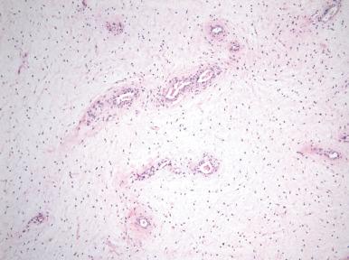 Fig. 9.11, Aggressive angiomyxoma. This paucicellular spindle cell neoplasm is punctuated by numerous thick-walled vessels.