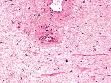 Fig. 9.12, Aggressive angiomyxoma. Bland spindle cells are set within a loosely collagenous and myxoid matrix. Brightly eosinophilic bands of smooth muscle are often present near the vessels.