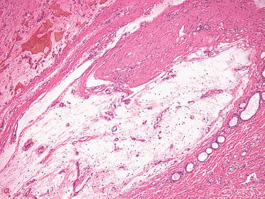 Fig. 9.13, Superficial angiomyxoma. This is a well-demarcated, multilobulated tumor located in the dermis.