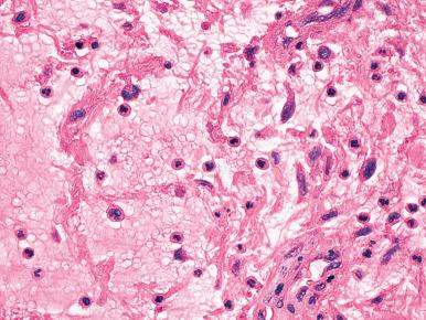 Fig. 9.14, Superficial angiomyxoma. Bland spindle cells are admixed with acute inflammatory cells.