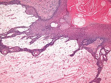 Fig. 9.15, Superficial angiomyxoma. An epithelial component is present in approximately one-third of cases.