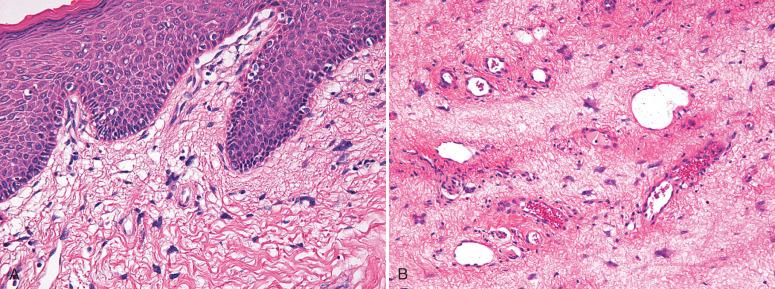 Fig. 9.2, Fibroepithelial stromal polyp. Stellate and multinucleate cells are typically present near the epithelial–stromal interface (A) and around the prominent vascular component (B) .