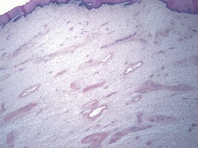 Fig. 9.3, Fibroepithelial stromal polyp. Edematous change may mimic an aggressive angiomyxoma.