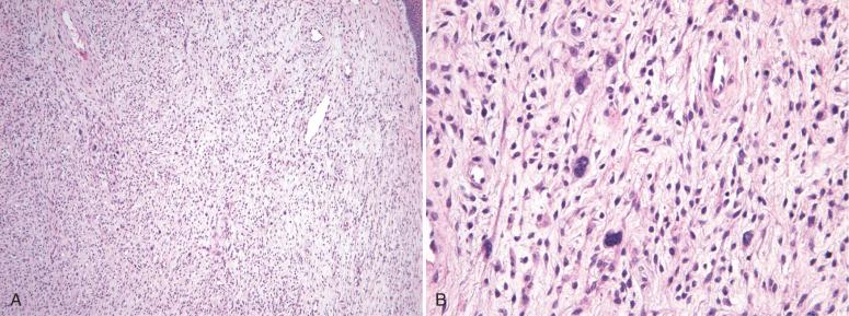 Fig. 9.4, Fibroepithelial stromal polyp. Hypercellularity and nuclear atypia may be present, particularly in those polyps removed during pregnancy. A, Note the lack of a clearly identifiable margin between the lesional stromal cells and epithelial interface (upper right). B, Cells with enlarged pleomorphic nuclei are scattered throughout this example of a pseudosarcomatous polyp.