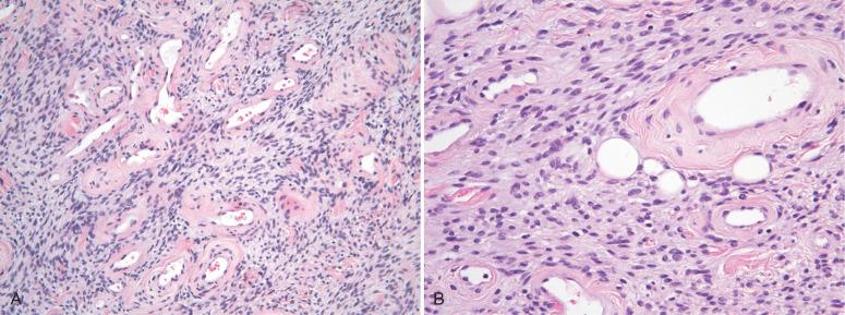 Fig. 9.6, Cellular angiofibroma. A, Short intersecting fascicles of bland spindle cells are set in a collagenous matrix interspersed with medium-sized vessels, with thickened hyalinized walls. B, A component of adipose tissue.