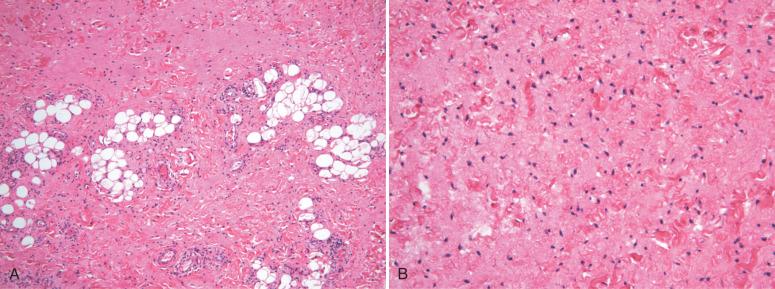 Fig. 9.8, Prepubertal vulval fibroma. A, A hypocellular patternless proliferation of spindle cells infiltrates adipose tissue. B, The bland-appearing spindle cells are set within a collagenous matrix.