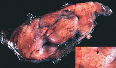 Fig. 9.10, Aggressive angiomyxoma. Ill-defined neoplasm with glistening cut surface. Numerous vessels are discernible (inset, arrow).