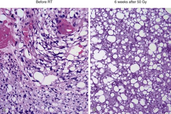 Fig. 75.2, Demonstration of the Exquisite Radiosensitivity of Myxoid Liposarcoma to Radiation.