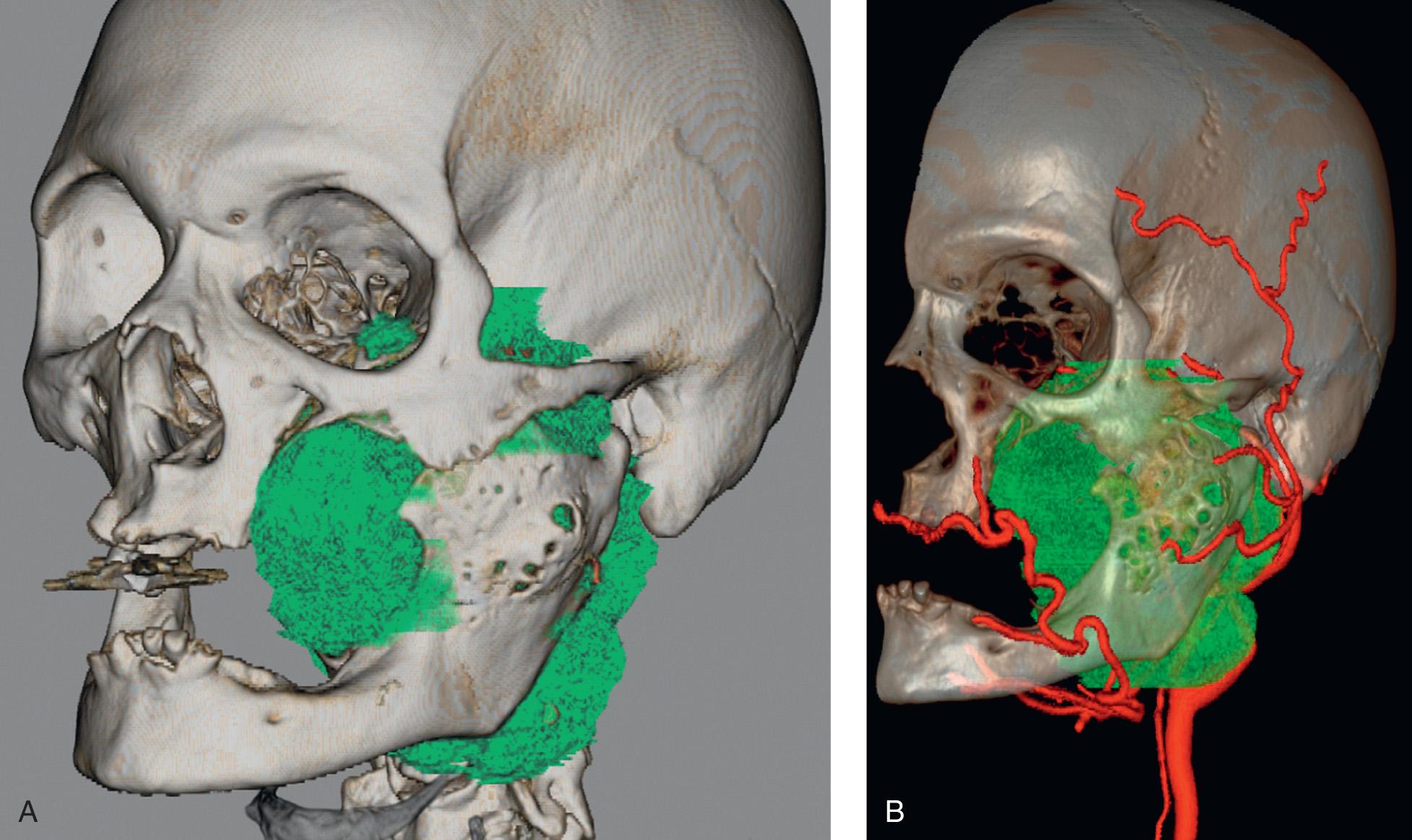 Figure 15.14, Three-dimensional reconstruction of computed tomography (CT) scan ( A ), and CT angiography showing the extent of the tumor in relation to its bony surroundings and the relationship of the arterial vasculature ( B ).