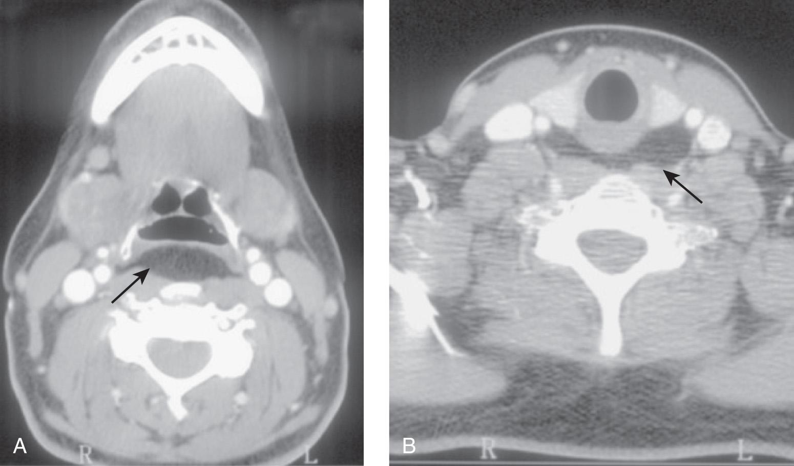 Figure 15.16, Contrast-enhanced computed tomography scan of the neck at the level of the epiglottis ( A ) and in the lower part of the neck ( B ) showing a lipoma in the prevertebral space ( arrow ).