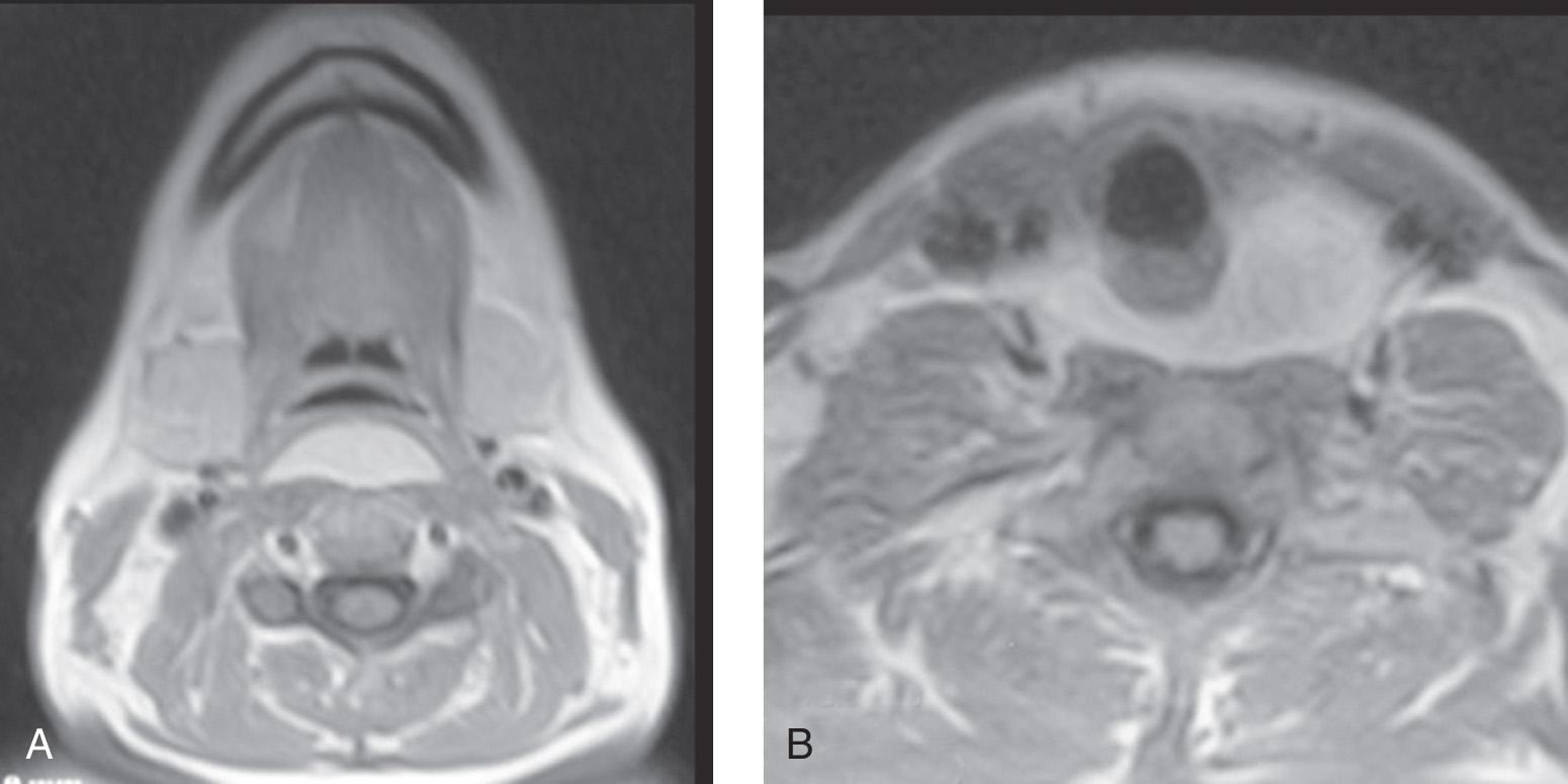 Figure 15.17, T1-weighted magnetic resonance images at the level of the epiglottis ( A ) and lower part of the neck showing a lipoma in the prevertebral space ( B ).