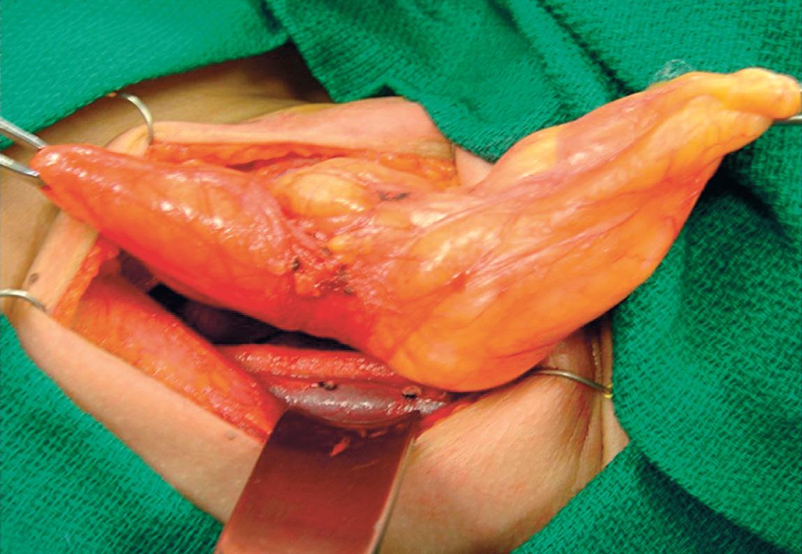 Figure 15.19, All lobulations of the lipoma are dissected and delivered out.