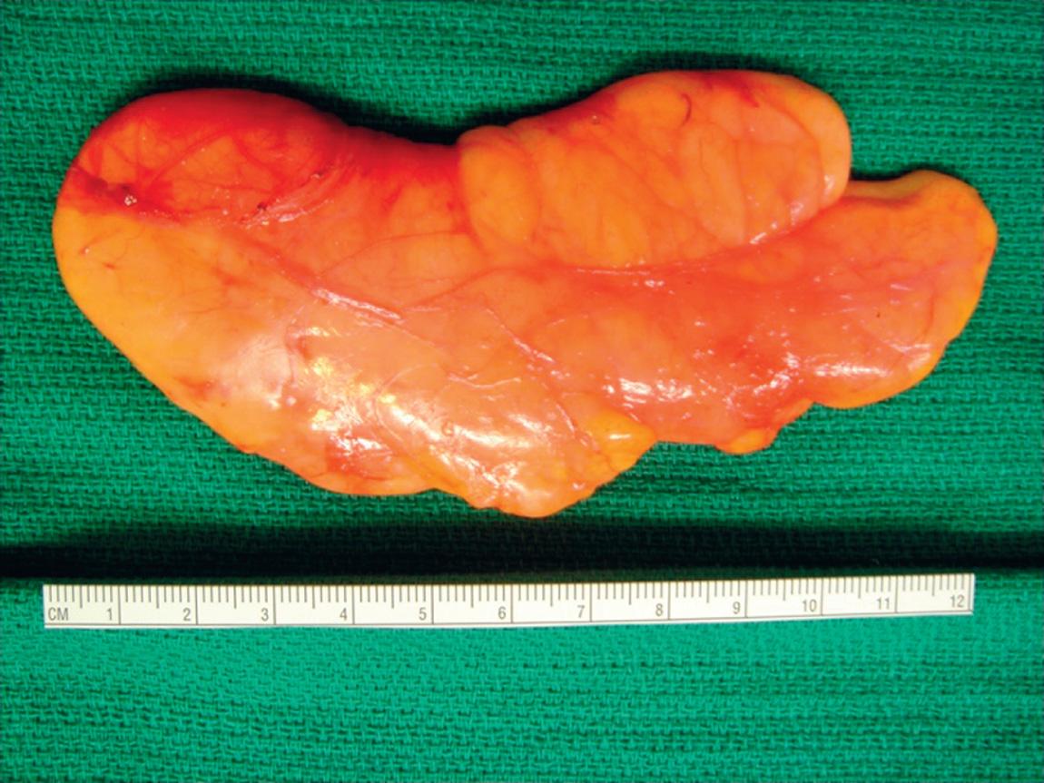 Figure 15.20, Surgical specimen showing complete excision of the lipoma with an intact capsule.