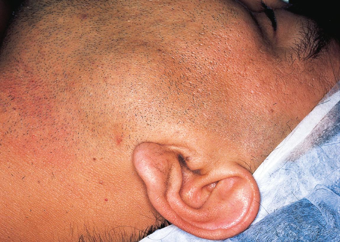 Figure 15.21, A patient with a soft mass at the tail of the parotid gland.