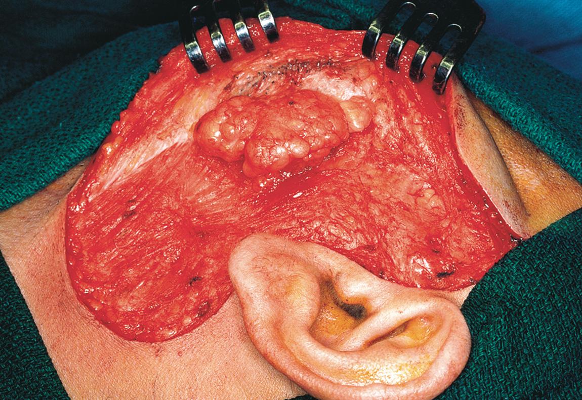 Figure 15.22, A lipoma overlying the tail of the parotid gland.