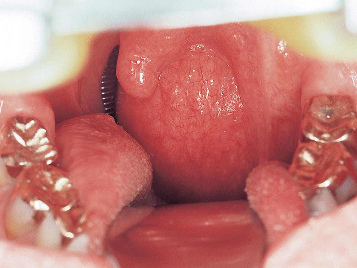 Figure 15.23, An intraoral view showing the submucosal bulge on the left posterolateral pharyngeal wall with the uvula pushed over to the opposite side.