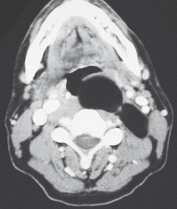 Figure 15.24, An axial view of the computed tomography scan showing the left prevertebral multilobulated tumor extending posterior to the carotid sheath into the parapharyngeal space.