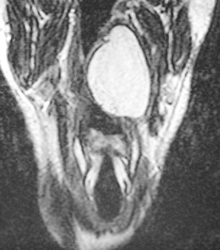 Figure 15.25, A coronal view of the magnetic resonance imaging scan showing the craniocaudad extent of the tumor.