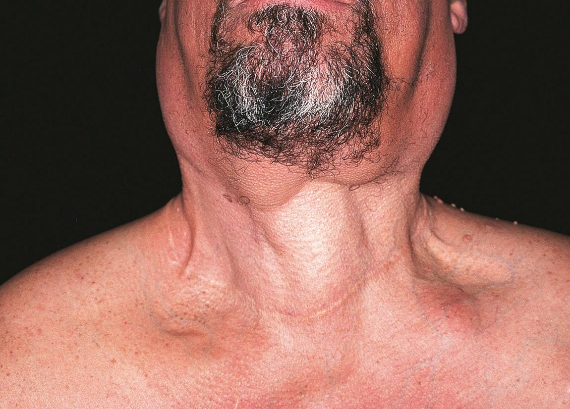 Figure 15.28, The patient's postoperative appearance after staged excisions.