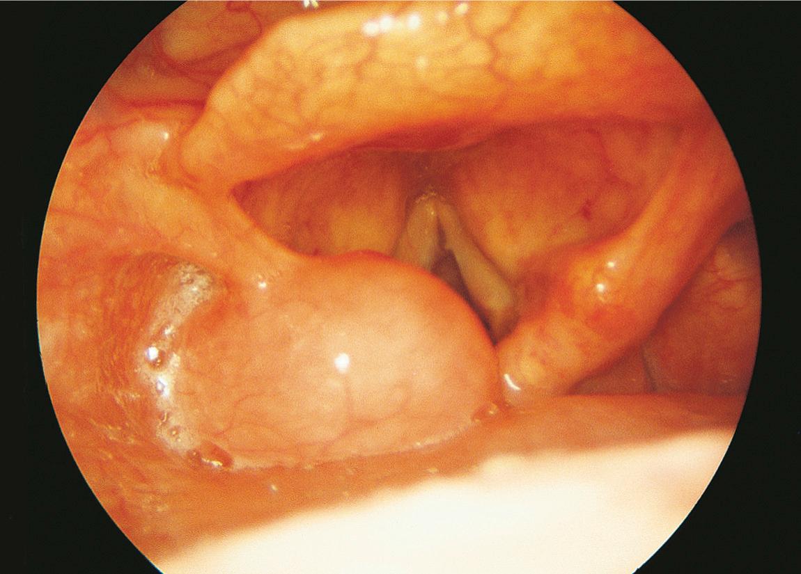 Figure 15.29, An endoscopic examination of the hypopharynx showing a smooth submucosal lesion.