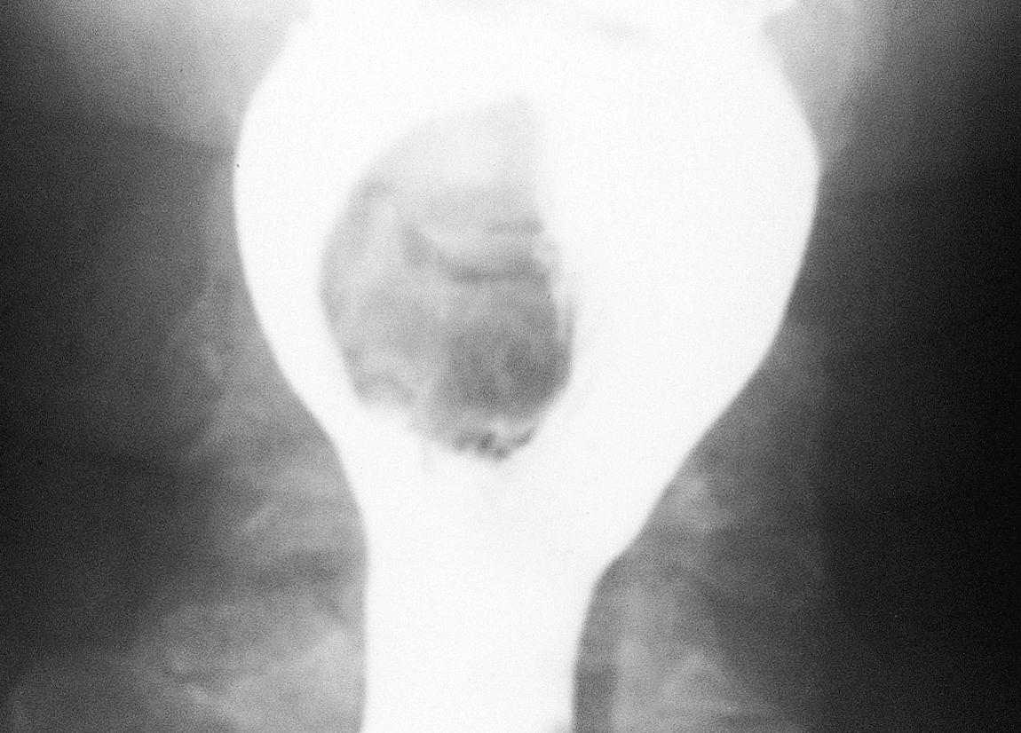 Figure 15.30, A barium swallow showing a filling defect in the left pyriform sinus.