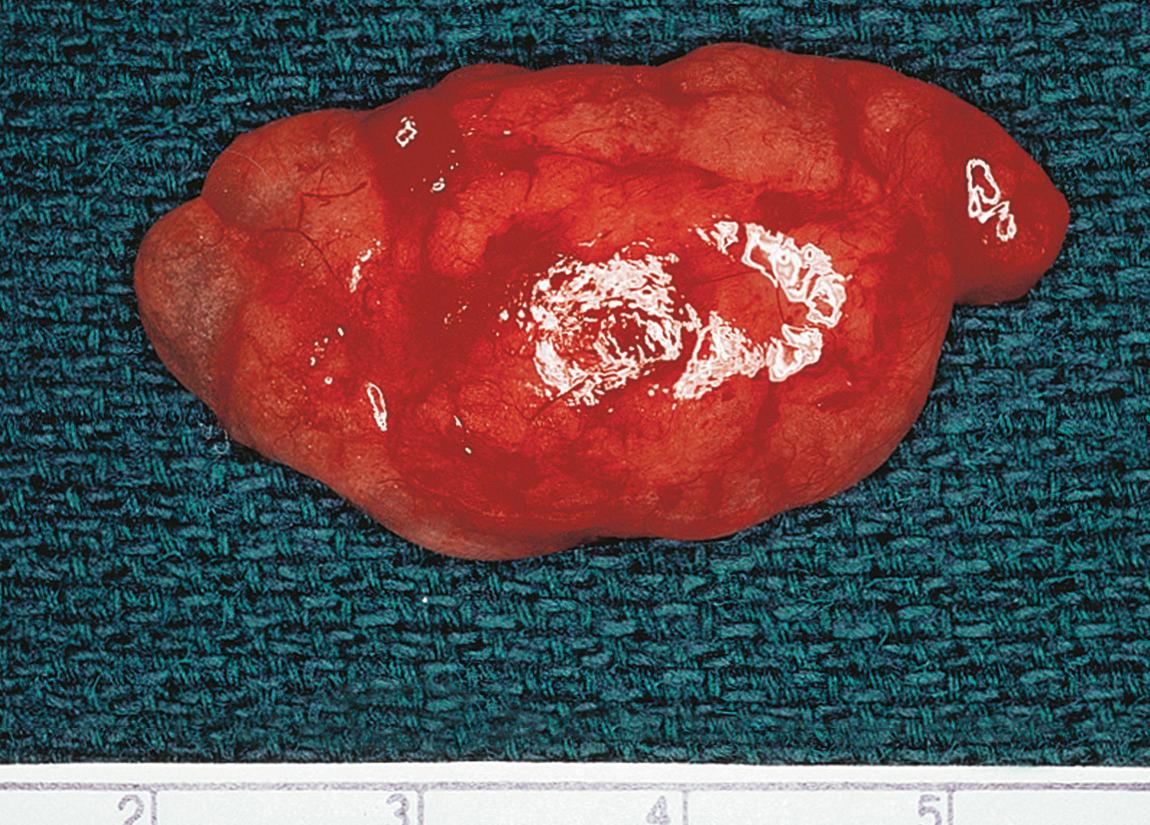 Figure 15.31, The surgical specimen.