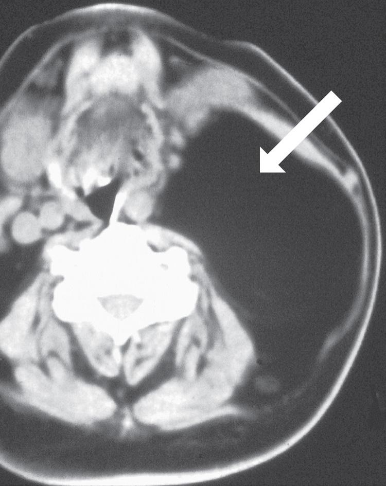 Figure 15.6, An axial view of a computed tomography scan showing a large lipoma ( arrow ) in the posterior compartment of the neck.