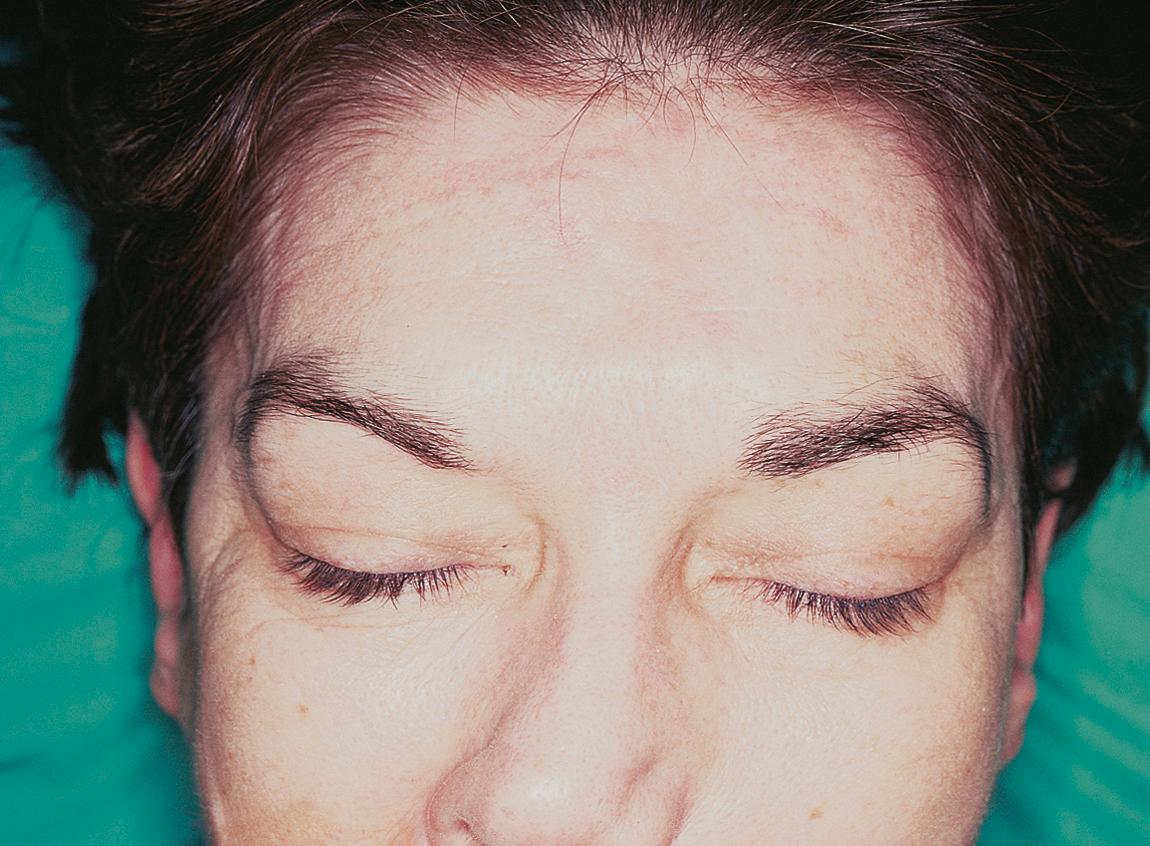 Figure 15.34, Dermatofibrosarcoma protuberans presenting as a multinodular lesion on the forehead.