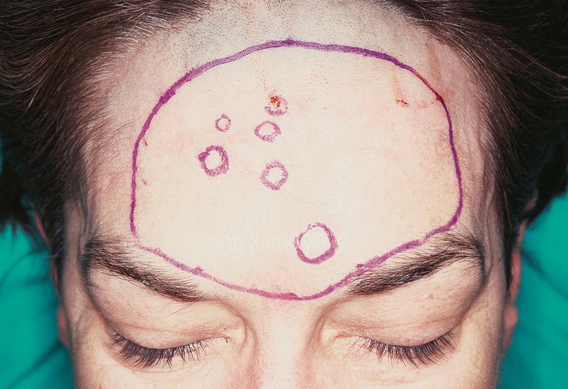 Figure 15.35, The extent of skin resection is outlined.