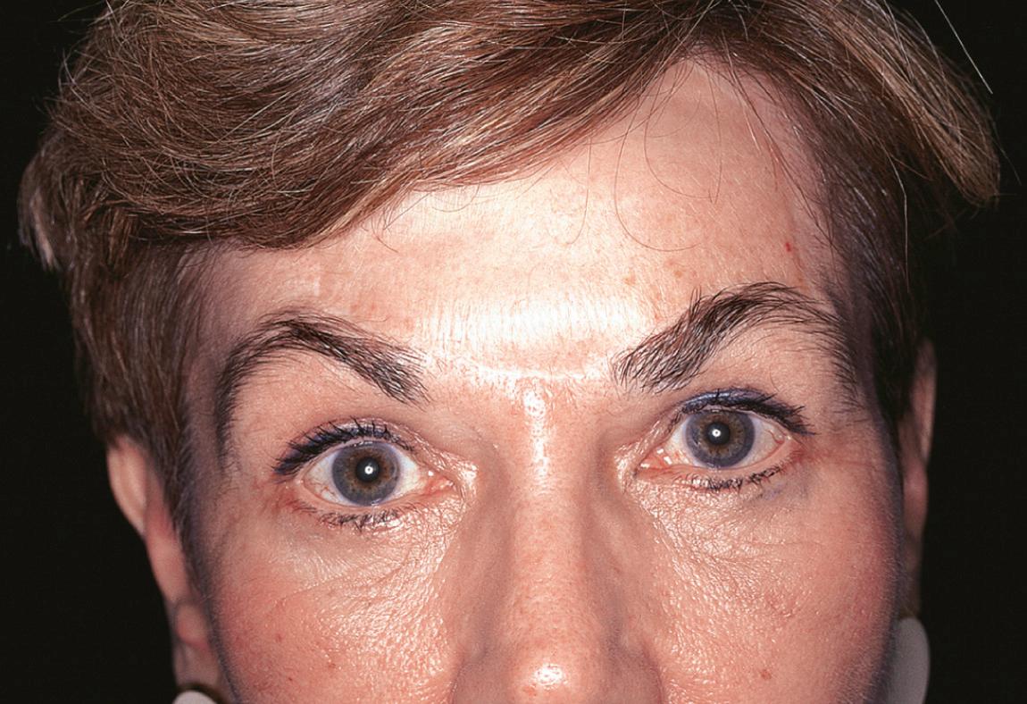 Figure 15.36, The appearance of the patient 2 years after surgery.