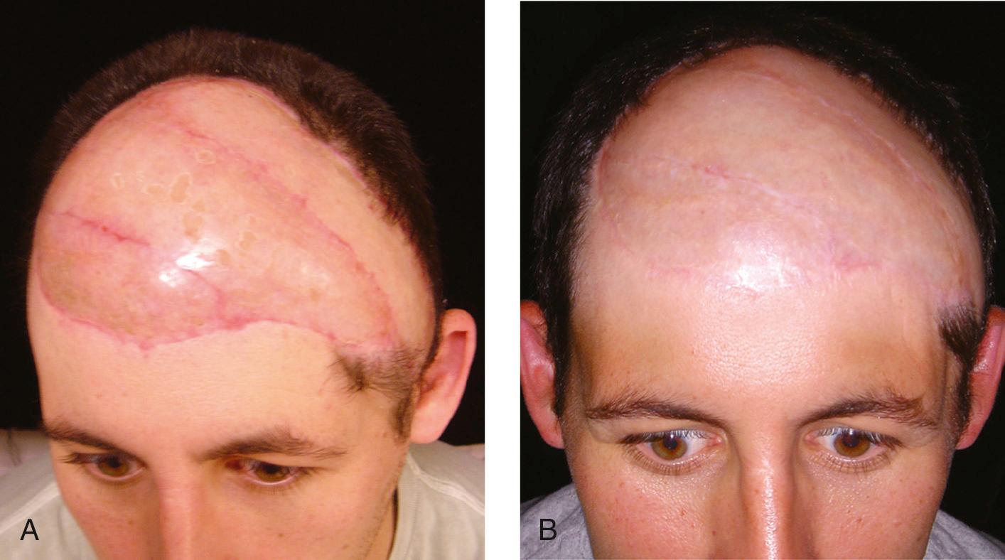 Figure 15.38, The patient's appearance after resection and reconstruction at 6 weeks ( A ) and 1 year ( B ).