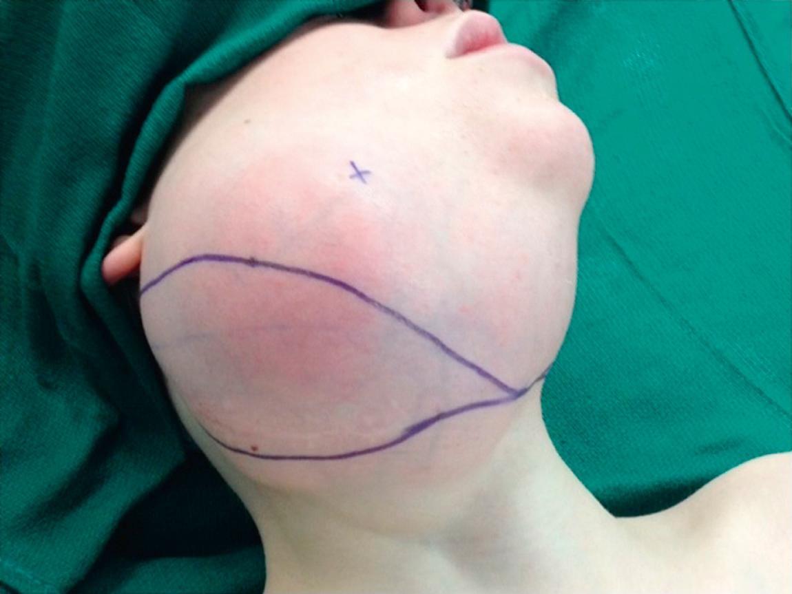 Figure 15.41, Plan of surgical excision with sacrifice of a segment of overlying skin.