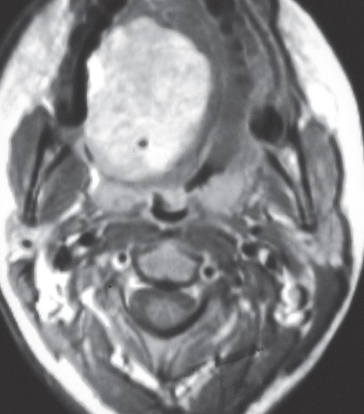 Figure 15.7, An axial view of the magnetic resonance imaging scan with a T1-weighted postcontrast image showing a well-circumscribed hemangioma of the tongue.