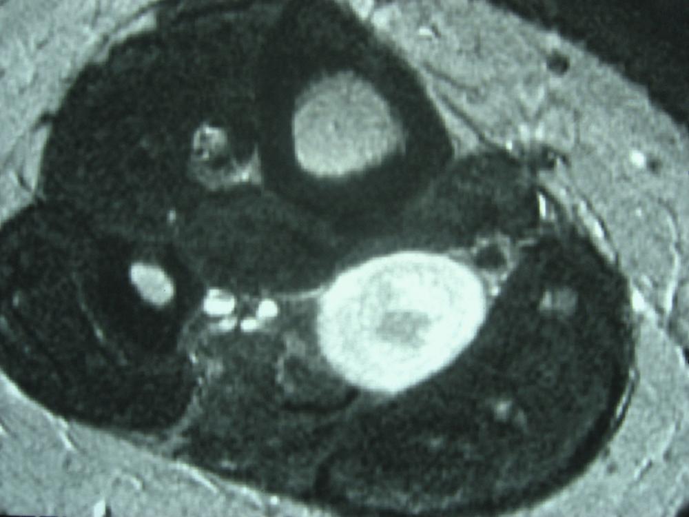 FIGURE 28.6, Target sign in axial MRI of schwannoma in posterior leg.
