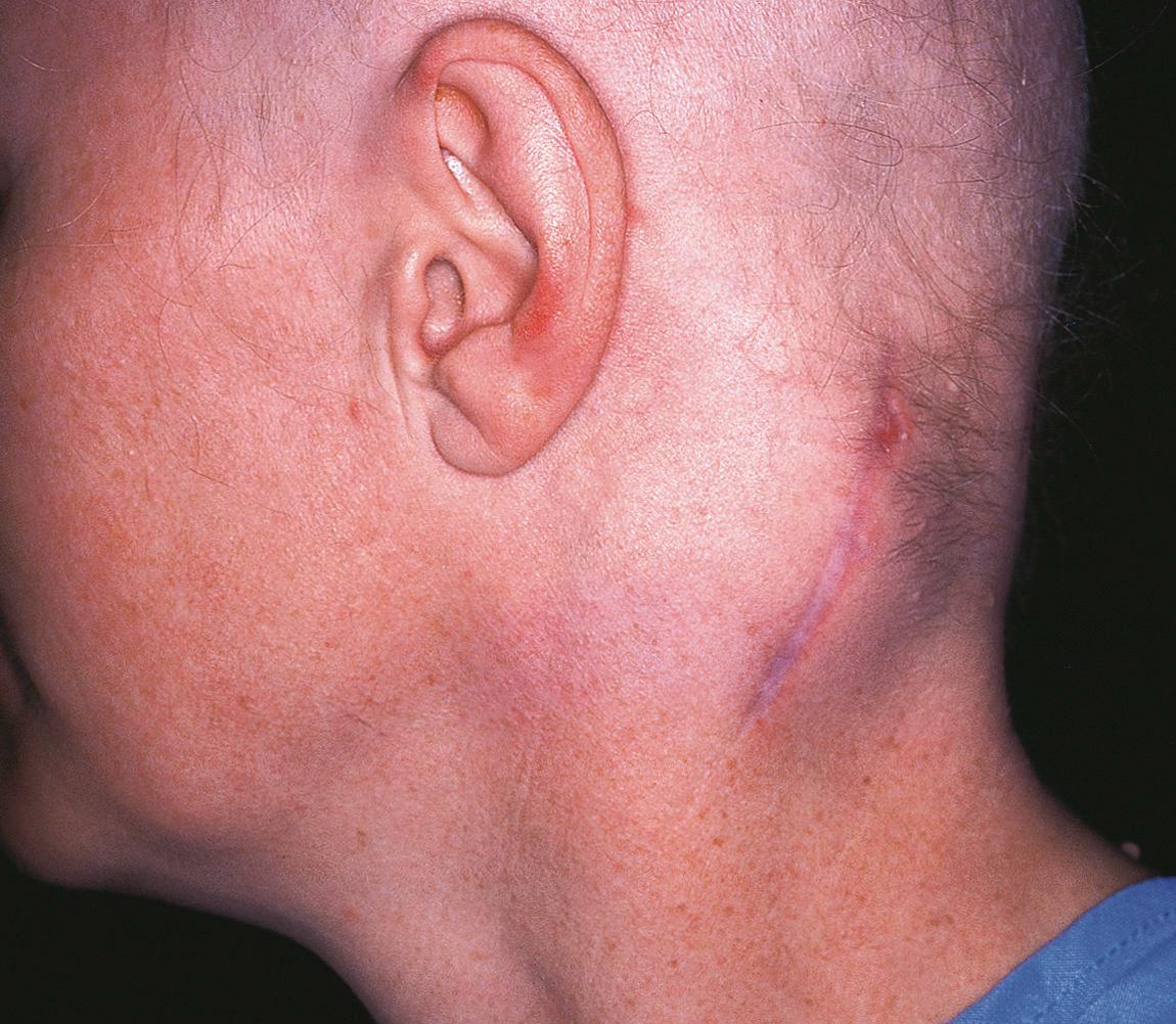 Figure 15.44, A patient with a mass on the left-hand side of her neck in the suboccipital region.