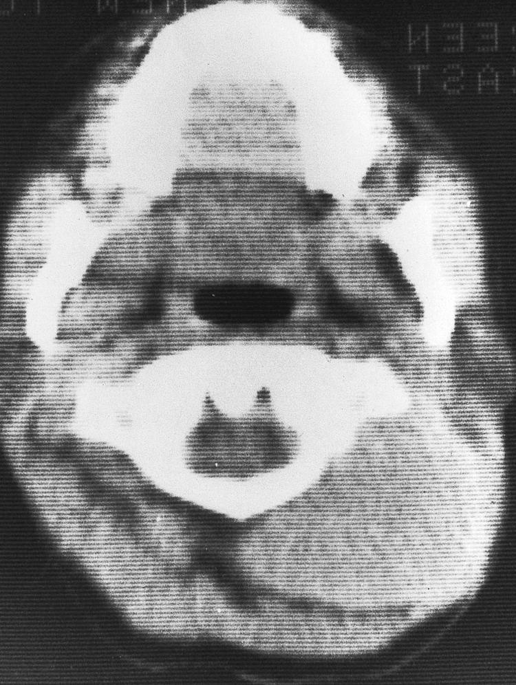 Figure 15.45, An axial view of the computed tomography scan showing a contrast-enhancing mass in the paraspinal region.