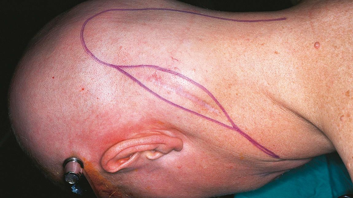 Figure 15.48, The patient's head is fixed in flexion with neurosurgical tongs, and the skin incision is outlined.